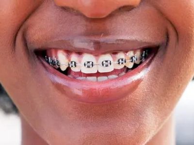 depositphotos_771519948-stock-photo-happy-smile-mouth-woman-braces_jpg_75